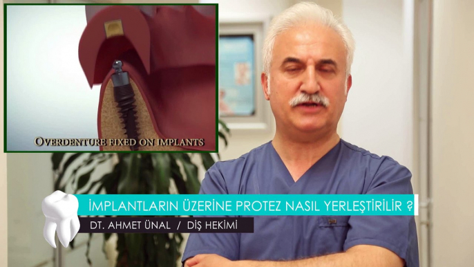 DT. AHMET ÜNAL / DİŞ HEKİMİ - İMPLANTLARIN ÜZERİNE PROTEZ YERLEŞTİRİLİR Mİ ?