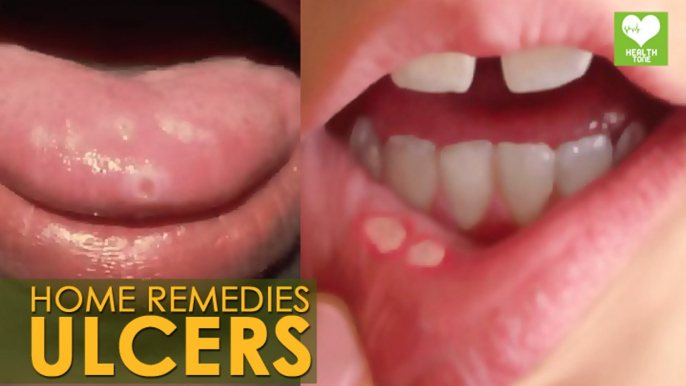 Ulcers Treatment - Home Remedies | Health Tips