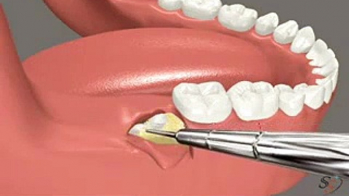 7- Impacted lower 3rd Molar Extraction (Disto Angular )