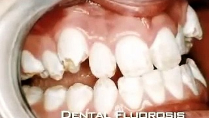 Professional Perspectives on Water Fluoridation - Part 2 of 3