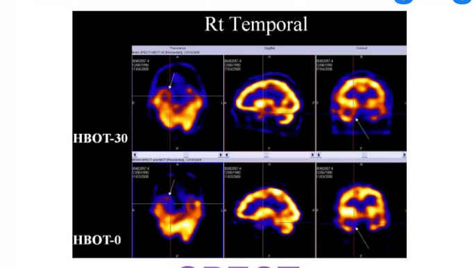 fMRI vs PET vs SPECT - functional neuroimaging