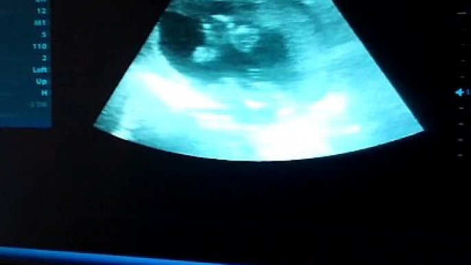 Ultrasound ni baby