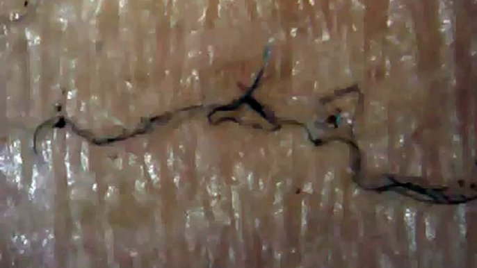 Morgellons  Bad skin day!