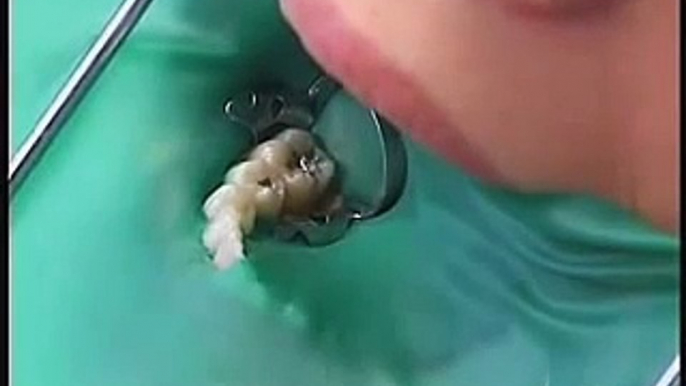 Root Canal Procedure