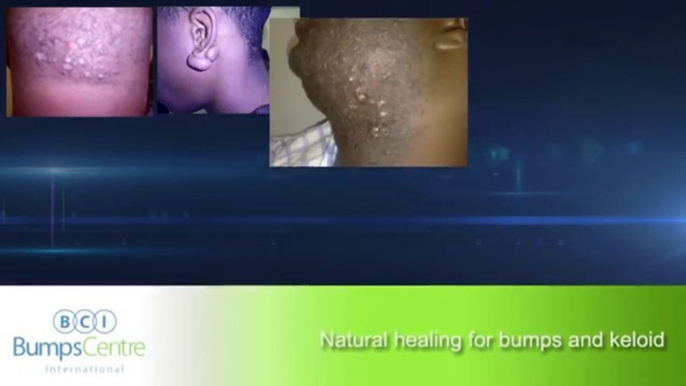 Natural Keloids Treatment, Removal of Razor Bumps, acne and all skin Problems