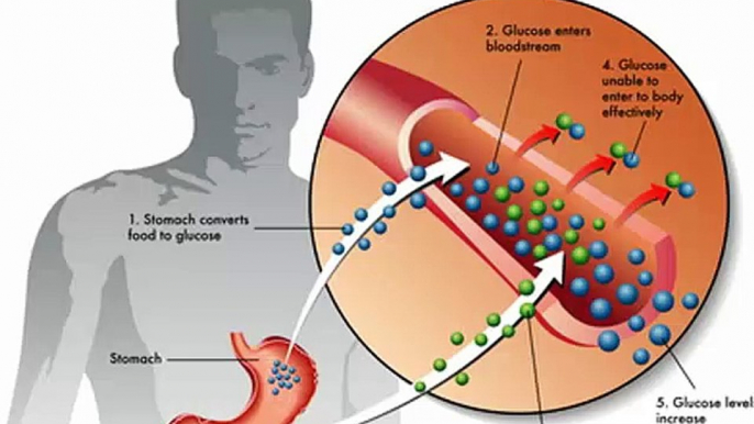 Diabetes  Factores en la Dieta para Diabeticos