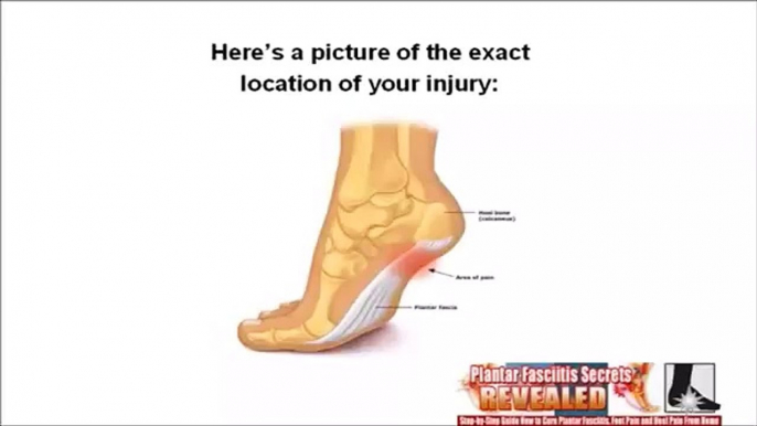 Plantar Fasciitis Treatment