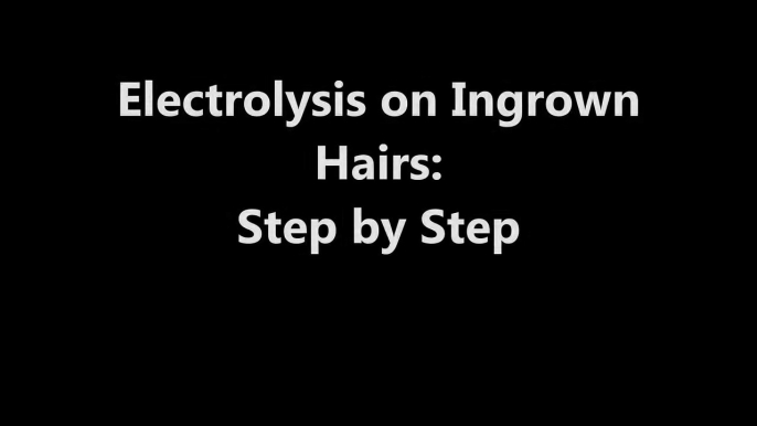 Electrolysis on Ingrown Hairs  Step by Step