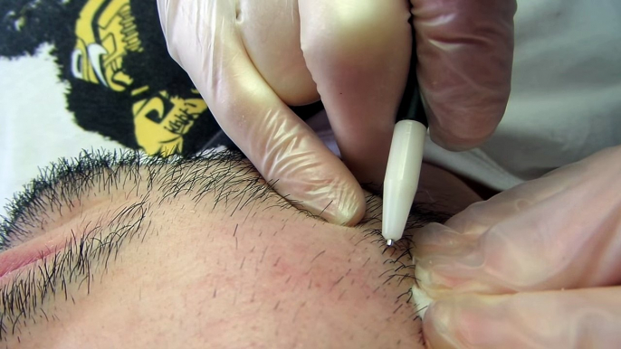 Electrolysis On Man Beard