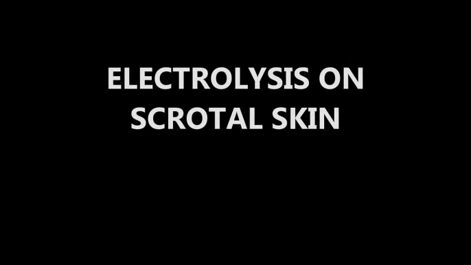 Electrolysis on Terminal Hairs