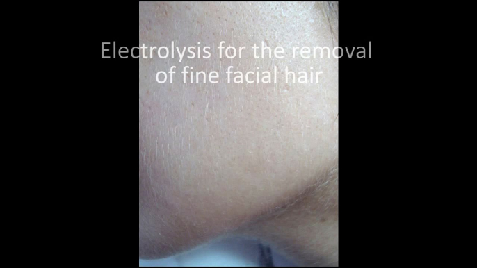 Electrolysis hair removal on the female face.