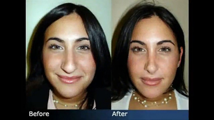 Rhinoplasty Before & After Plastic Surgeon New York