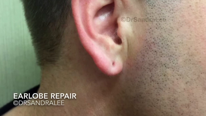 Earlobe repair from plugs that dilated pierced holes. For medical education- NSFE.