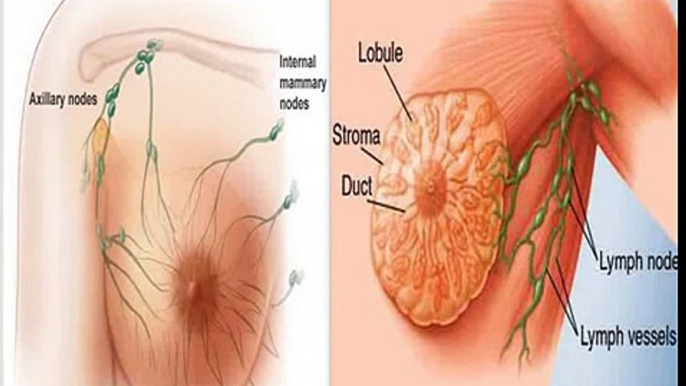 Breast Cancer symptoms, Diagnosis, Treatment, Prognosis - Complete Documentary