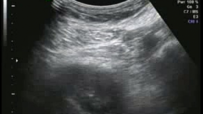 10 - week Ultrasound