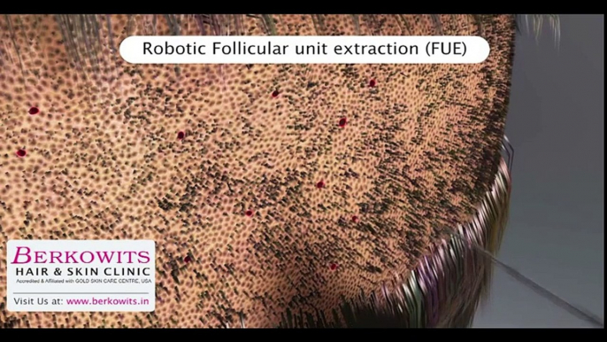 Robotic Hair Transplant Delhi, Robotic Hair Transplant india,Robotic Hair Transplant services, Robotic Hair Transplant