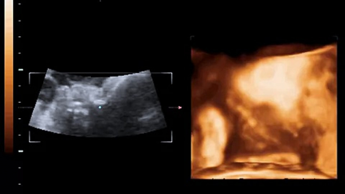 3D\4D  19 weeks Ultrasound - Dr.Refaat Al-Sheemy LIVE