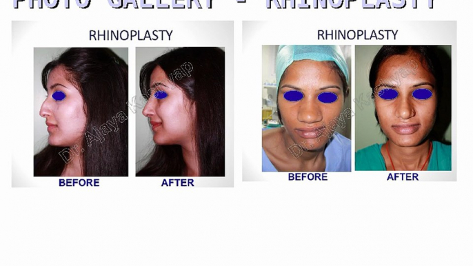 Nose Reshaping in Delhi - Rhinoplasty Surgery in Delhi