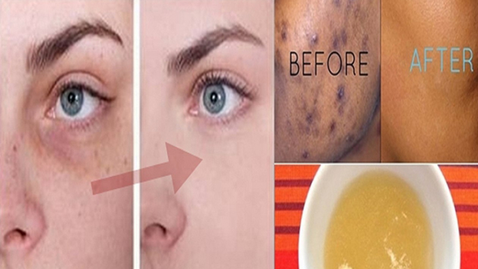 How To Remove Acne Scars, Dark Spots, And Dark Circles Naturally!