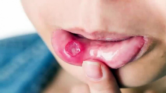 Home Remedies for Canker Sores