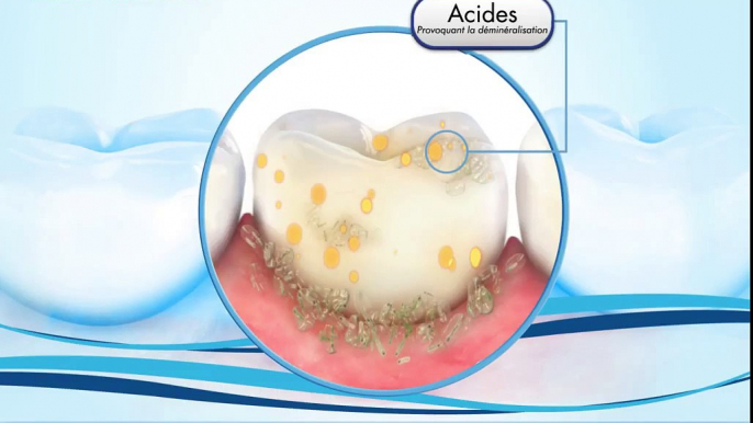 Caries dentaires - Informations, Conseils & Traitements - Oral-B