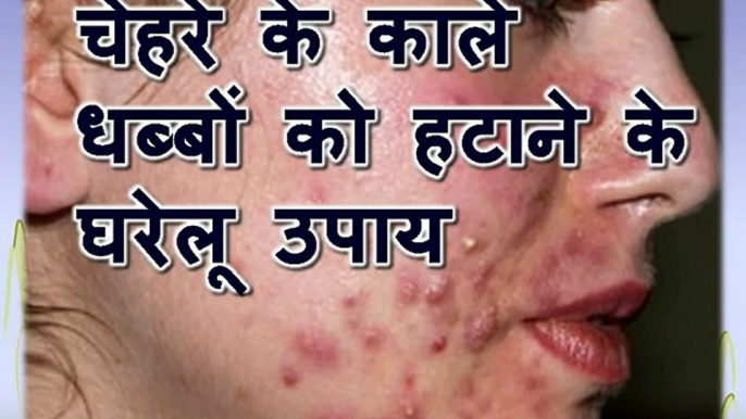 Pimple and acne tips in Hindi – चेहरे के काले धब्बों को हटाने के घरेलू उपाय