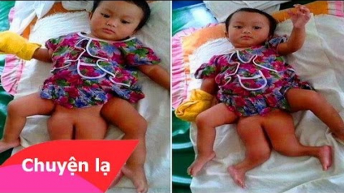 Chuyện lạ có thật – Em bé dị nhân có 4 chân