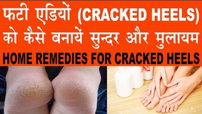 फटी एड़ियां (CRACKED HEELS) को कैसे बनायें मुलायम | Home Remedies For Cracked Heels In Hindi