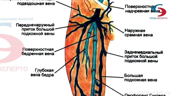 Чем лечить варикоз вен на ногах. Варикозное расширение вен на ногах симптомы лечение. Варикоз операция