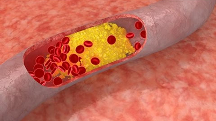 Quels sont les différents types de maladies cardiovasculaires ?