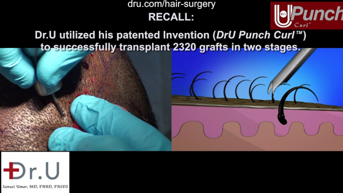 DrUPunch Curl, Best Tool For FUE Hair Transplant for Black Men In Los Angeles