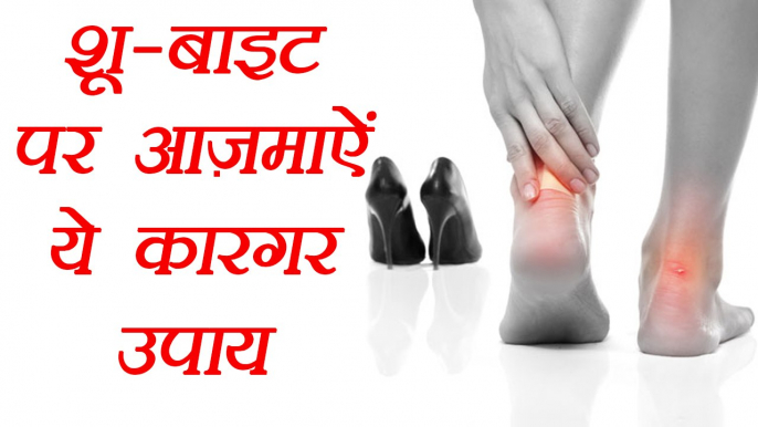 Shoe Bite Home Remedies | जूते के काटने पर करें ये उपाय | Foot Blister's Remedies | BoldSky