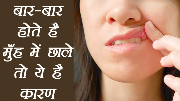 Mouth Ulcer Reason and treatment, बार-बार होते है मुँह में छाले तो ये है कारण | BoldSky