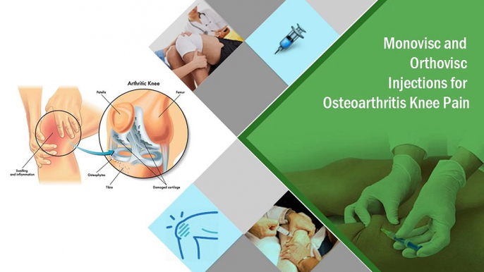 Monovisc and Orthovisc Injections for Osteoarthritis Knee Pain Treatment