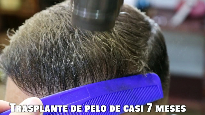 Cómo usar TOPPIK. ¿Se pueden usar FiBRAS CAPILARES después de un TRASPLANTE DE PELO?