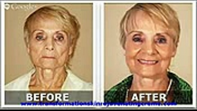 Instant Anti Wrinkle Cream Lifecell All In One Anti Aging Treatment