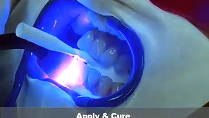 Dental teeth whitening (teeth bleaching)