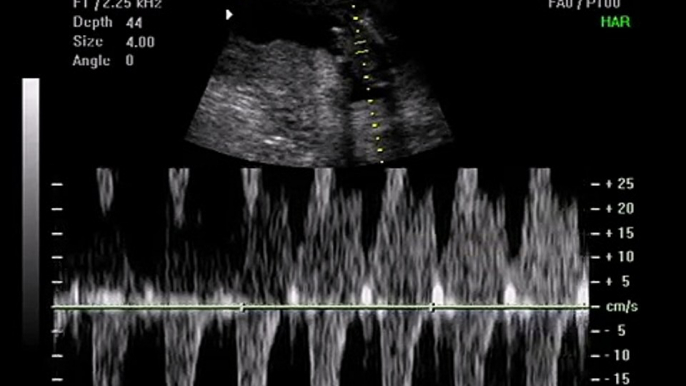 12 Weeks Pregnant Gender Determination Ultrasound