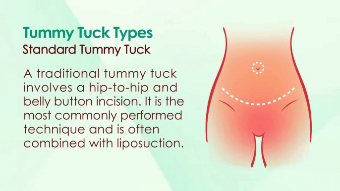 Tummy Tuck Surgery - Types, How Long it Takes and Recovery