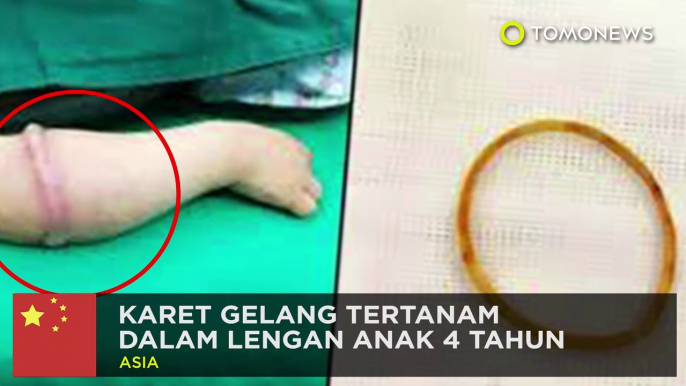 Karet gelang masuk ke dalam lengan bocah berusia 4 tahun - TomoNews