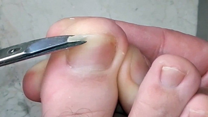 Ingrown Toenail Removal