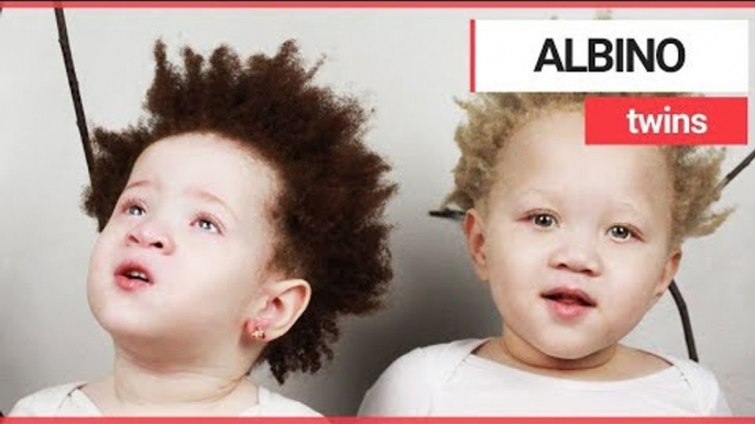 Parents of rare albino twins accused of having affairs | SWNS TV