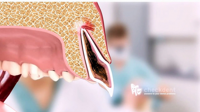 Jeder Zahn ein Organ - oder doch nur eine Fistel?