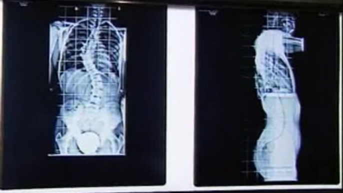 Doctores españoles desarrollan una nueva técnica para corregir la escoliosis