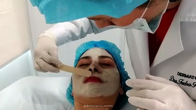 Peeling Quimico Facial | Renueva tu Piel