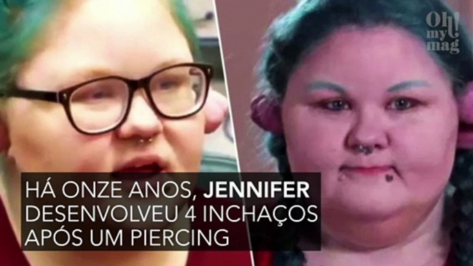 Desde que colocou um piercing há 11 anos, suas orelhas não param de inchar