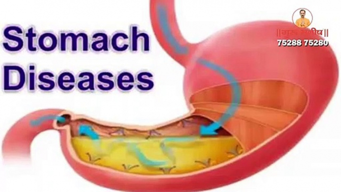 Ulcer | Causes | Types | Symptoms | Risk Factors | Signs | Ayurvedic Treatment | Guru Manish