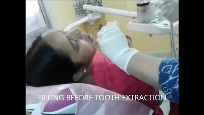 tooth, extraction, Tooth Extraction, Gross, Satisfying, Painless, dentistry, zerodonto, fabio cozzolino, sonic surgery, semi-impacted wisdom tooth, impacted wisdom tooth, oral surgery, dental guide