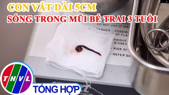 Phát hiện con vắt dài 5cm trong mũi bé trai 3 tuổi tại Phú Thọ