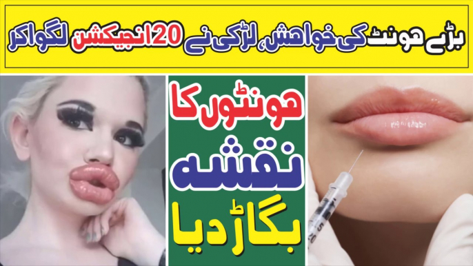 Desiring Big Lips, The Girl Distorted The Shape Of Her Lips By Giving 20 Injections